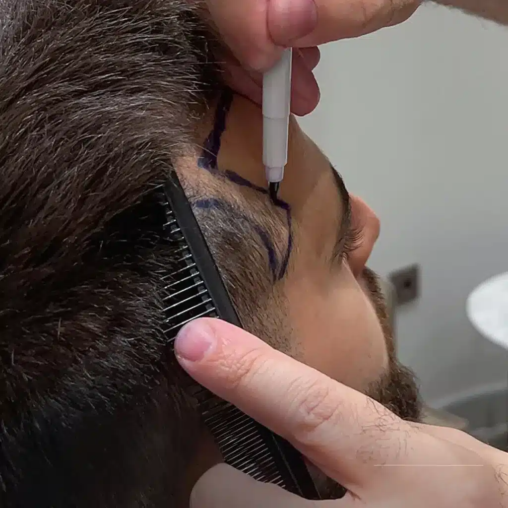 hair-transplant-before-after-hairline-1024x1024