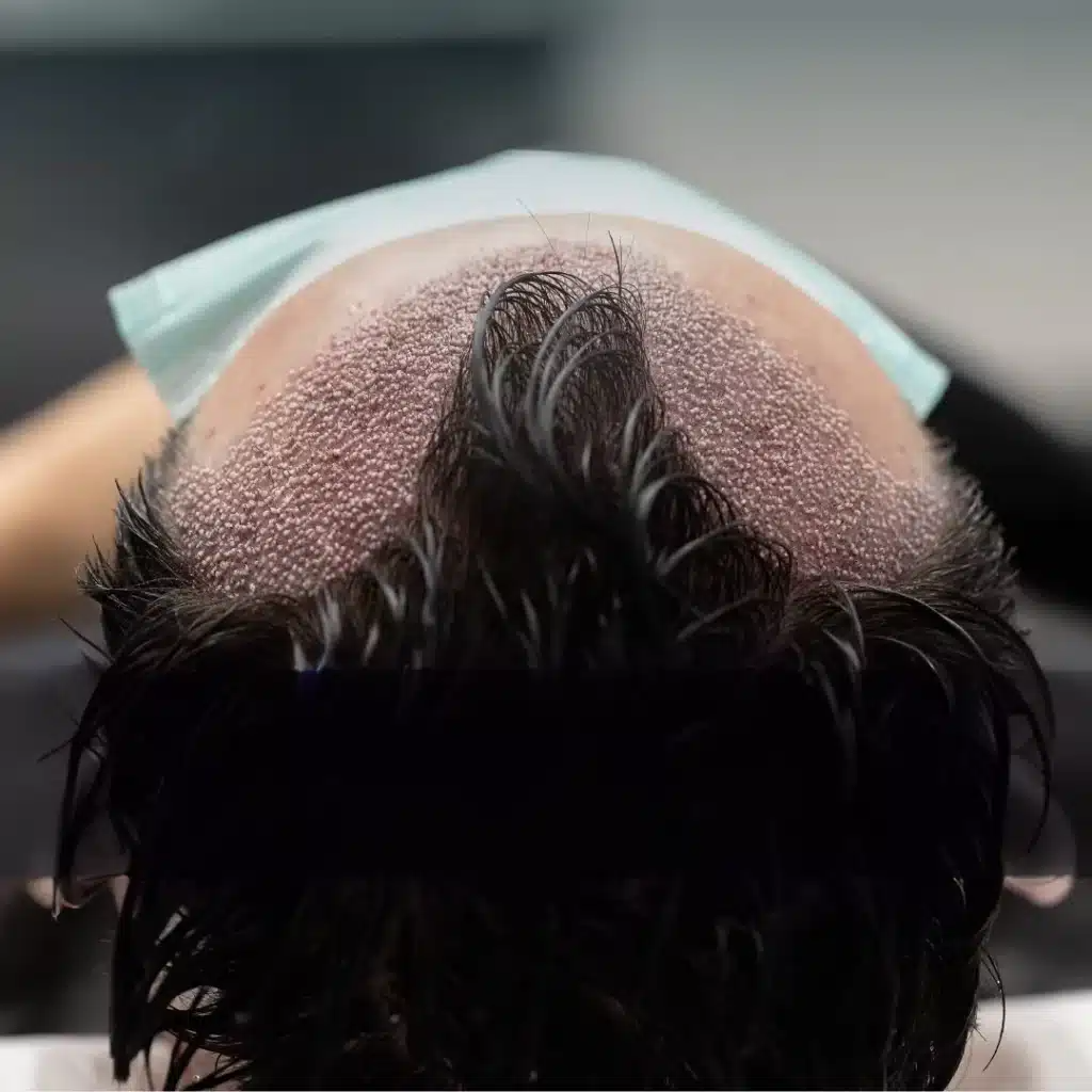 hair-transplant-before-after-transplanted-hair-1024x1024